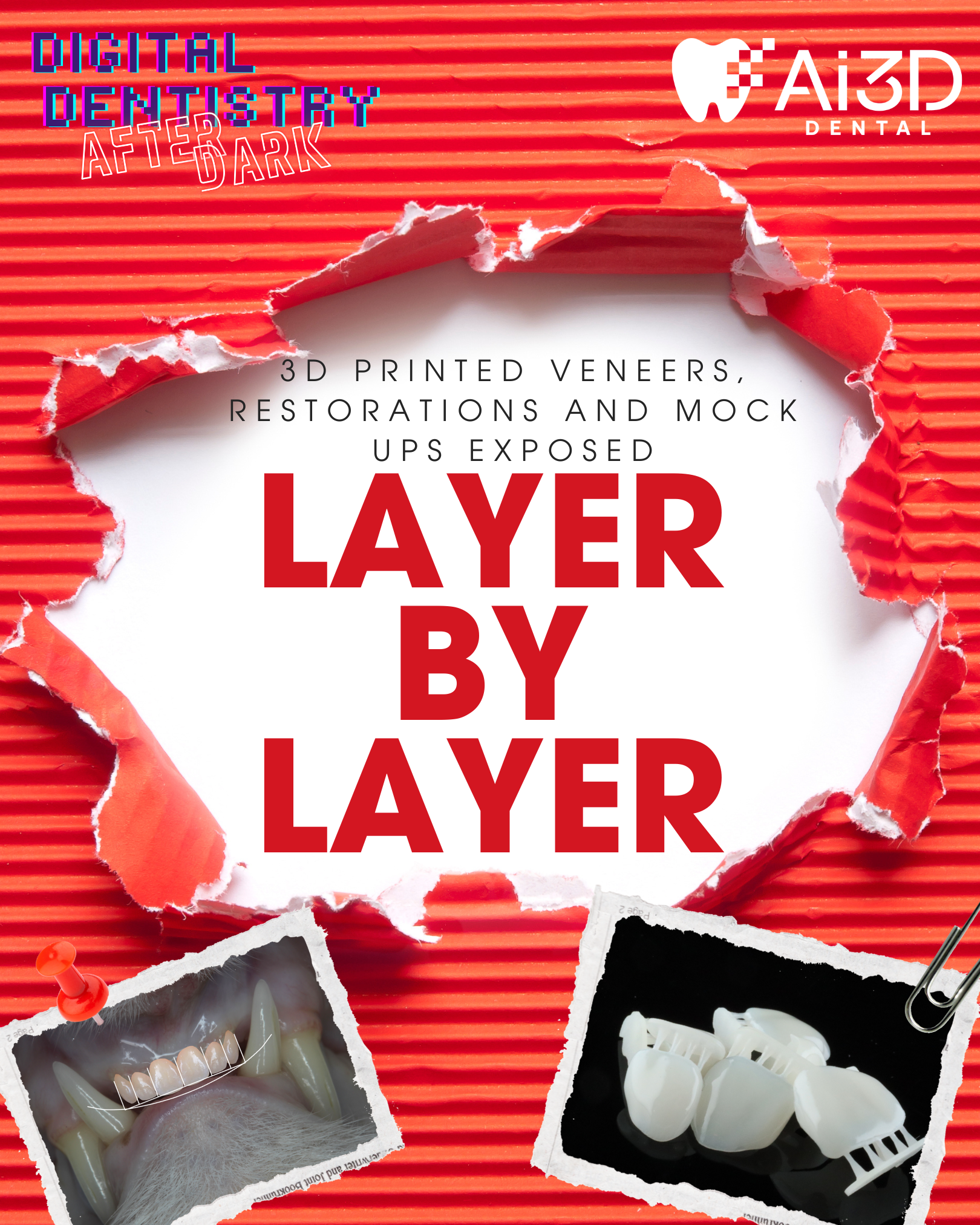 3D-printed veneers, restorations and mock ups exposed — layer by layer